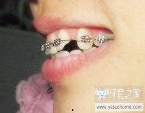 带牙套照片,带牙套前的美丽蜕变瞬间